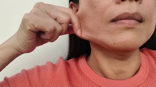 Flacidez: Causas, Tratamentos e Como Preveni-la