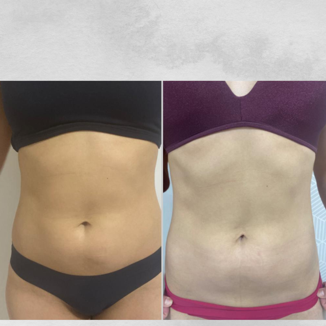 Bioestimulador nos Glúteos Antes e Depois