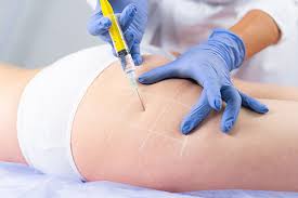 Bioestimulador de Colágeno Corporal