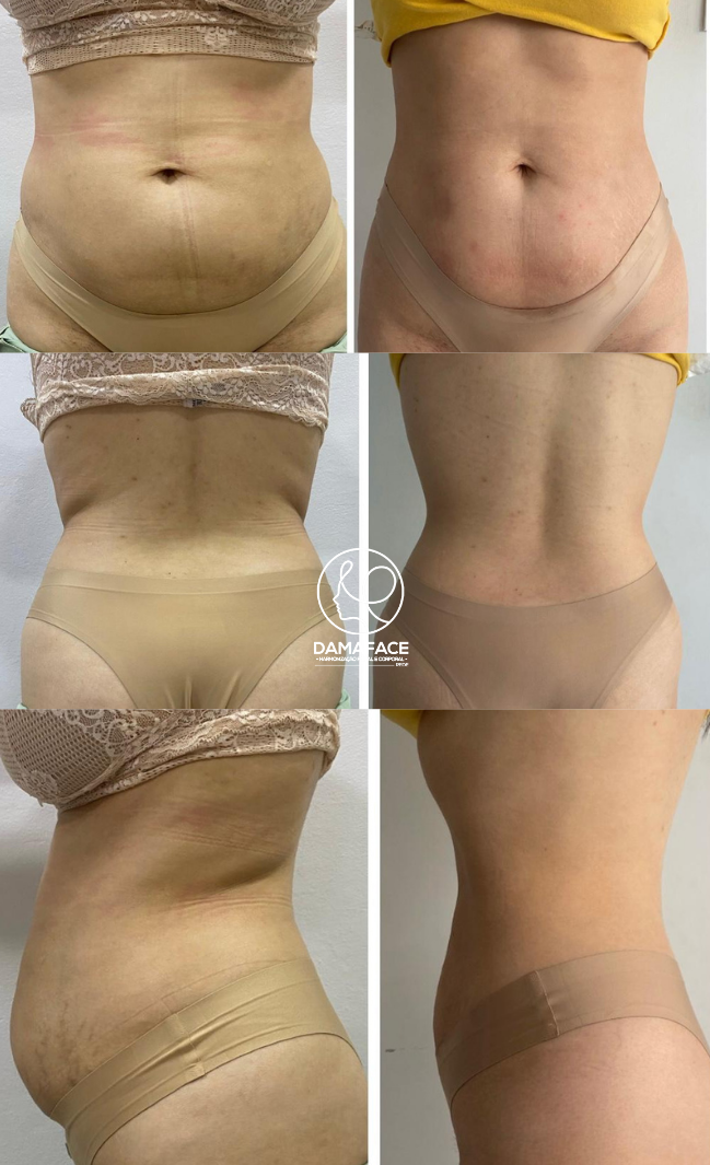 Melhora na Gordura Localizada Abdominal - Antes e Depois 10