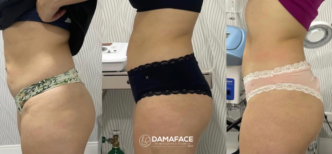 Resultados Visíveis de Gordura no Abdômen - Antes e Depois 2