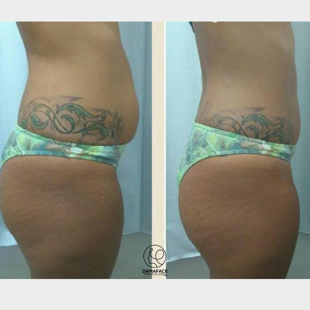 Resultados de Enzimas para Gordura no Abdômen - Antes e Depois 6