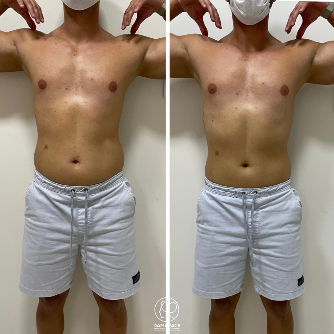 Redução Abdominal Natural - Antes e Depois 7