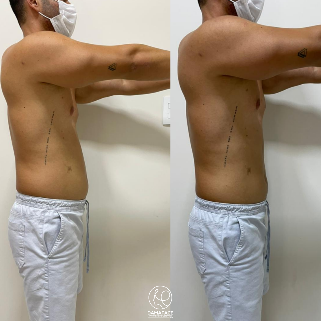 Transformação Visível da Gordura Localizada - Antes e Depois 8