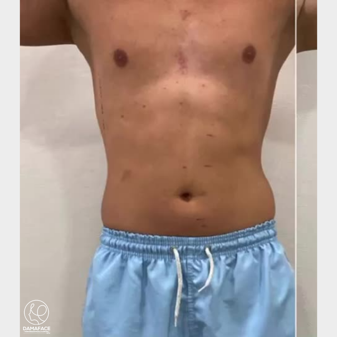 Resultados Reais de Gordura no Abdômen - Antes e Depois 9