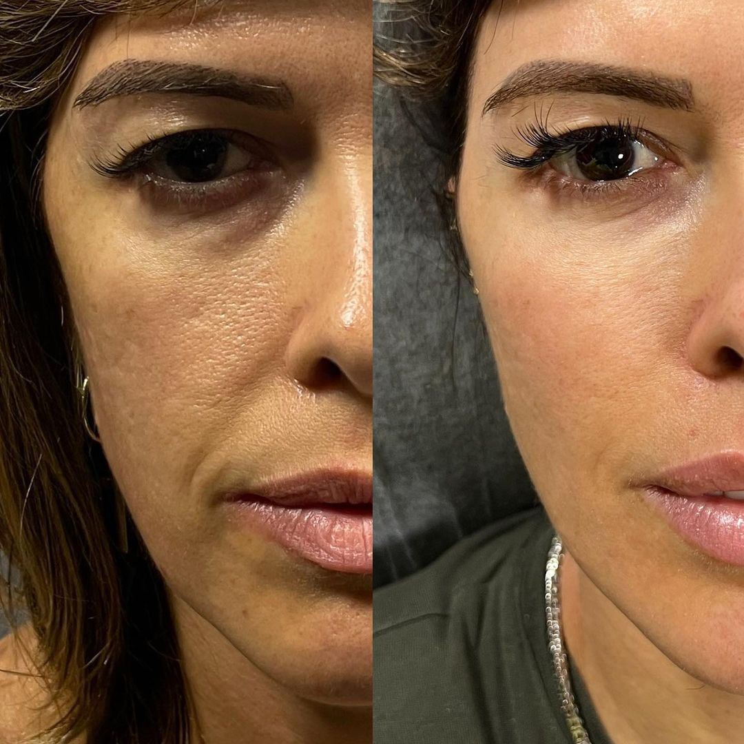 Lavieen Antes e Depois - Rejuvenescimento