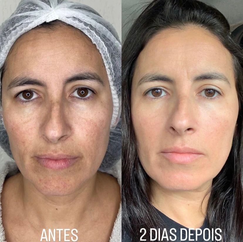 Lavieen Antes e Depois - Clareamento