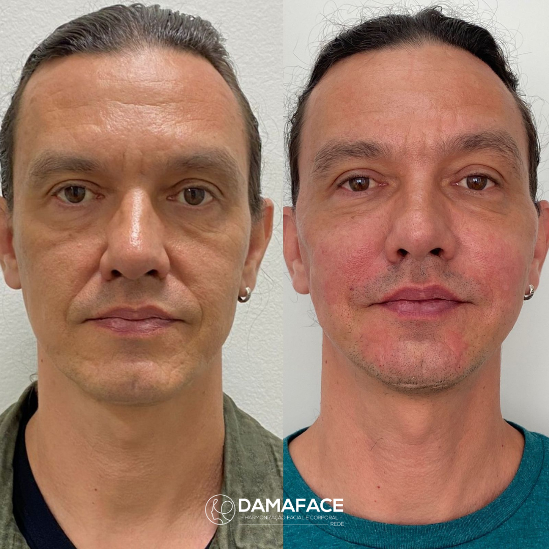 Bioestimulador de Colágeno Masculino