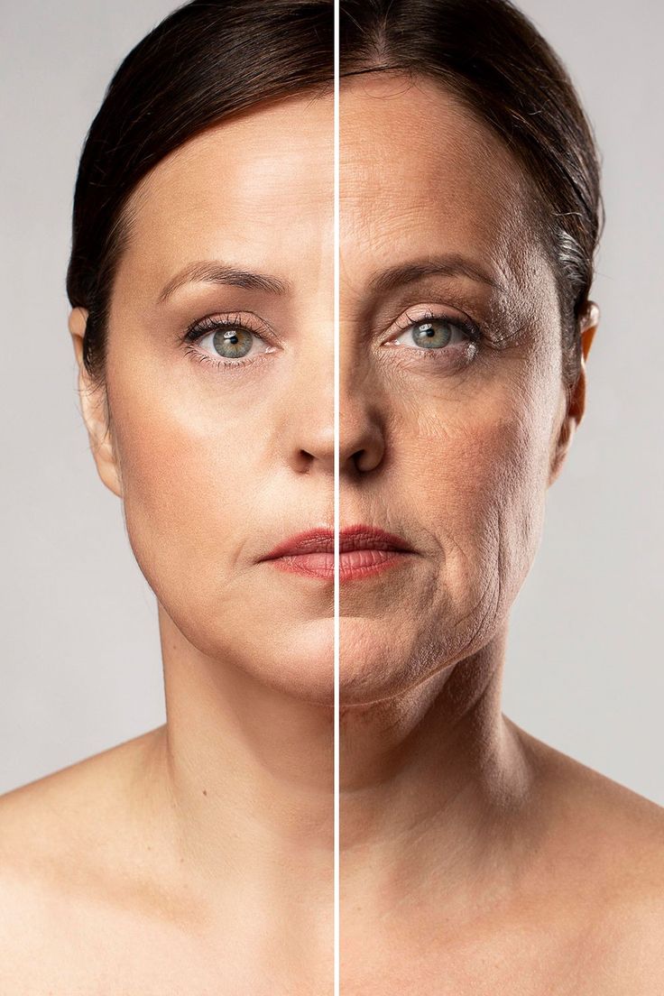 Bioestimulador de Colágeno