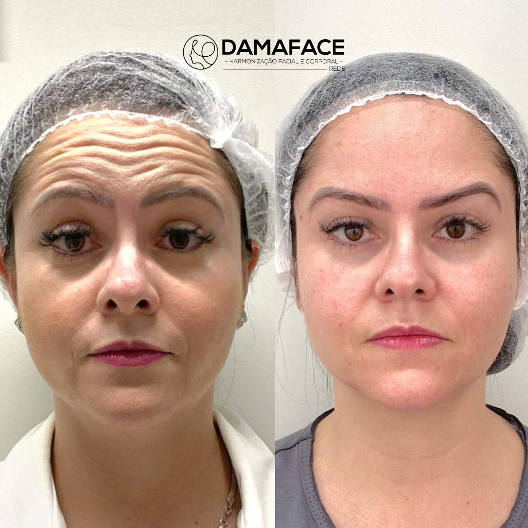 Botox Antes e Depois