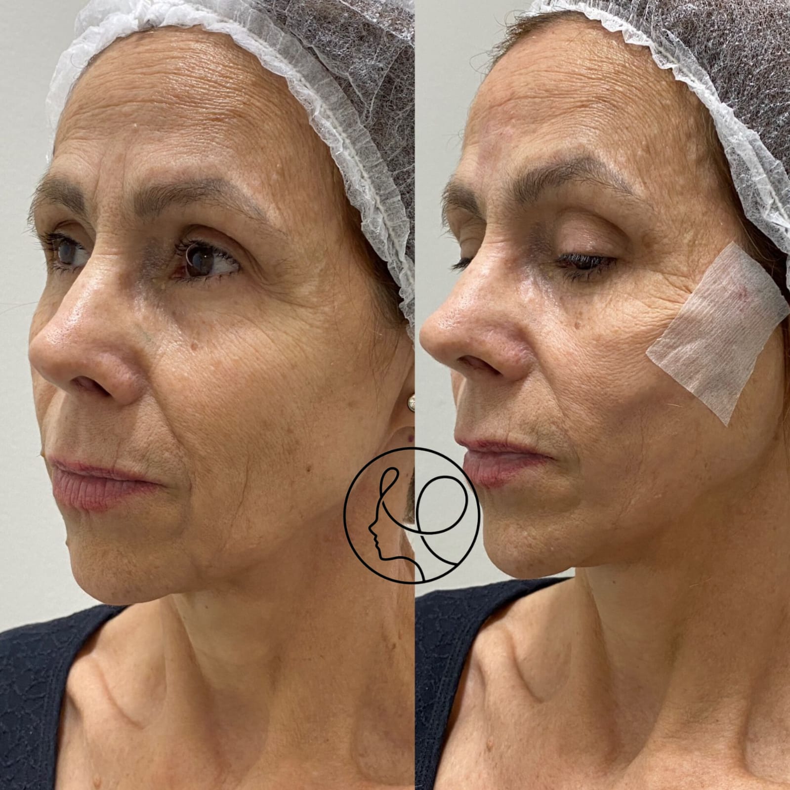 Fios de Sustentação Antes e Depois