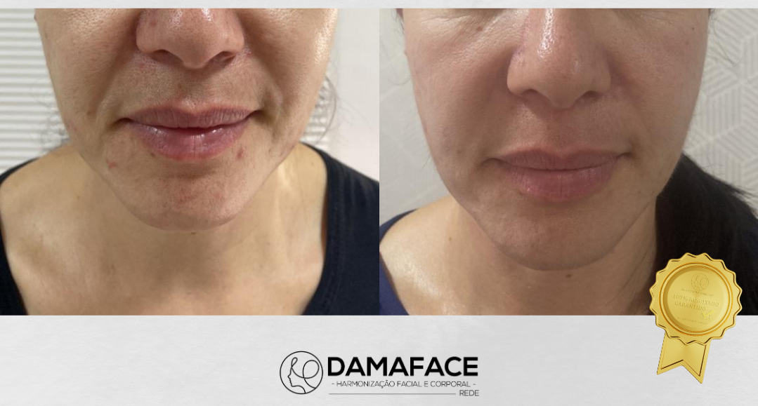 Resultado com Fios de Sustentação