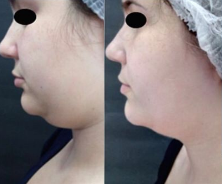 Antes e Depois Redução de Papada