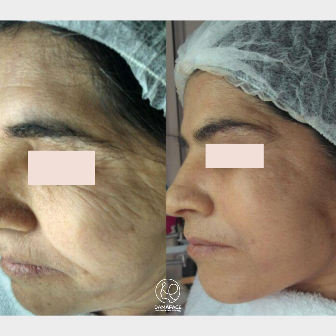 Microagulhamento Antes e Depois Rugas