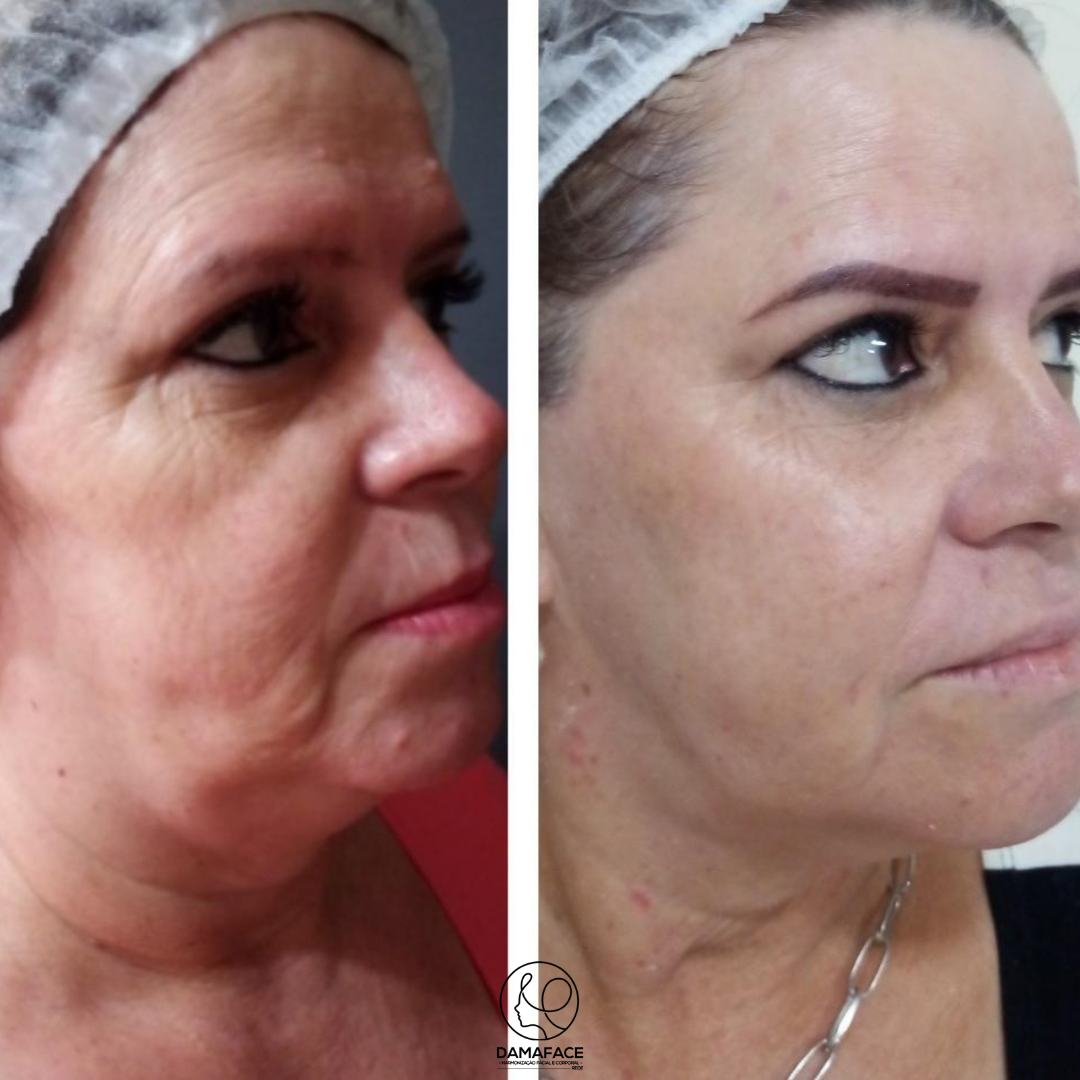 Peeling Químico Antes e Depois