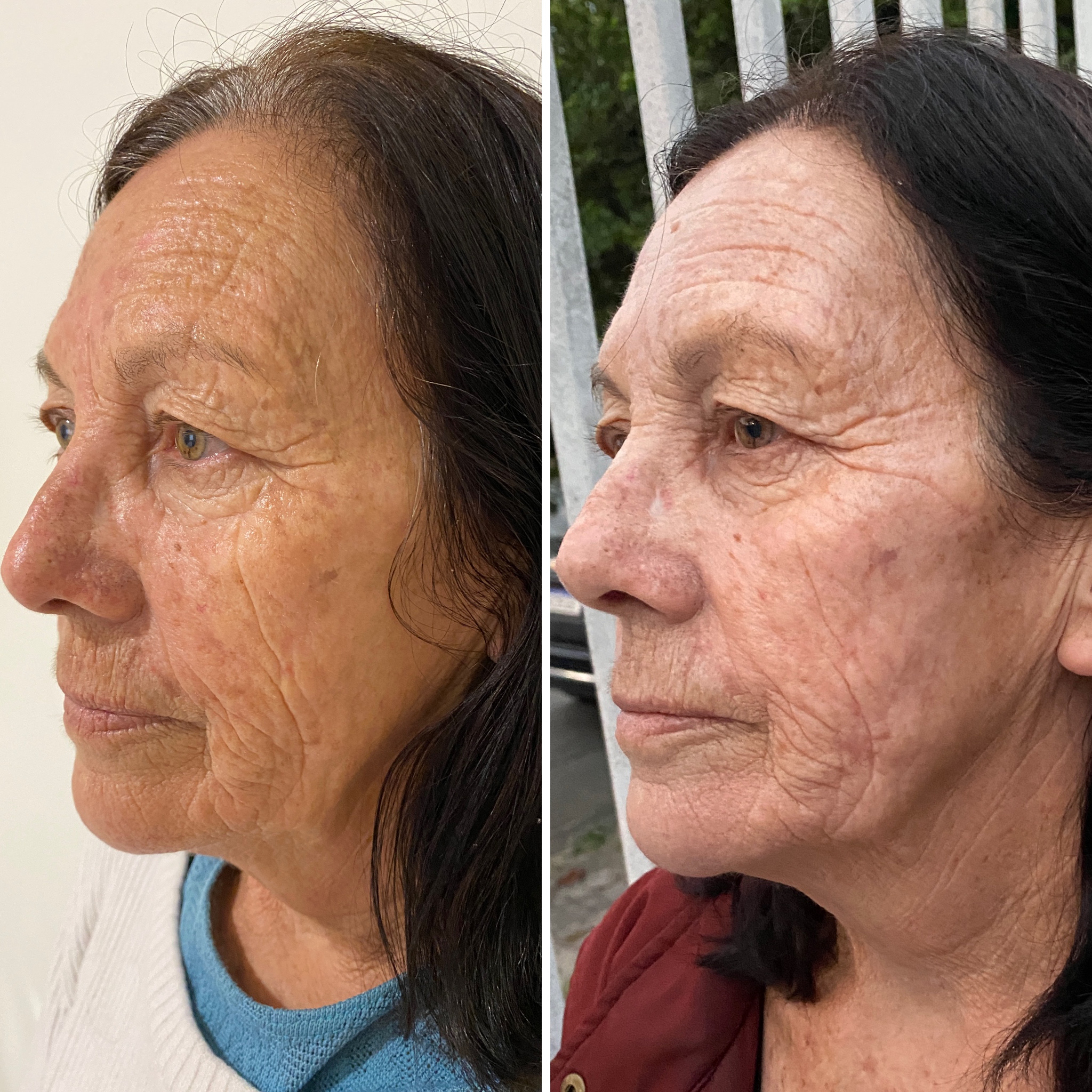 Resultado Peeling para Manchas