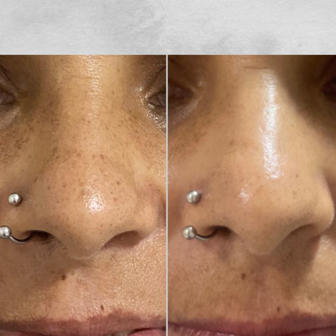 Pele Renovada com Peeling Químico