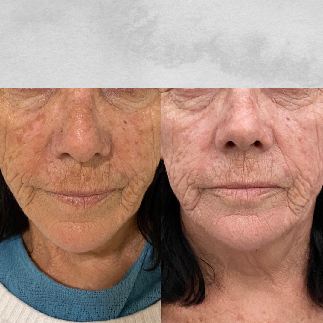 Paciente Feliz após Peeling Químico