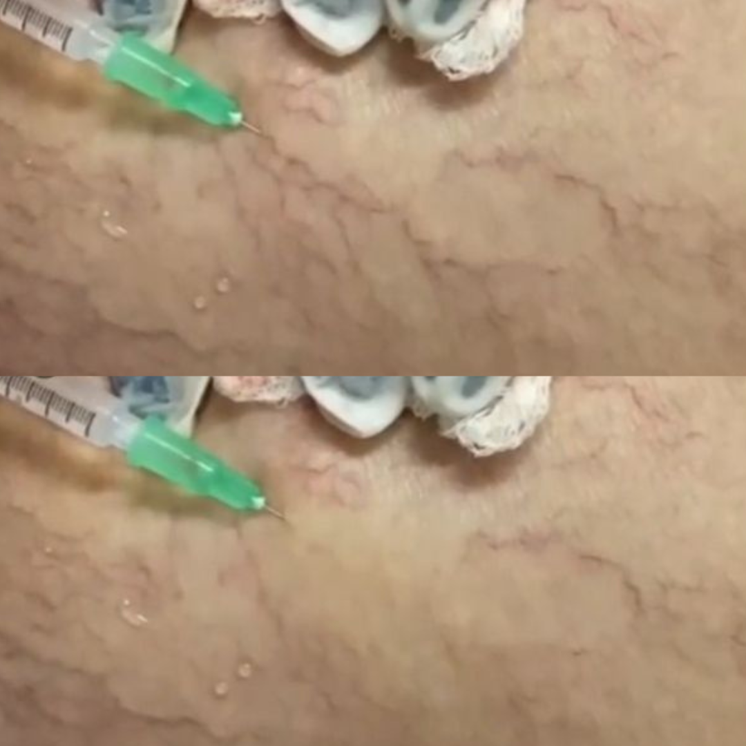 Resultado de PEIM Antes e Depois