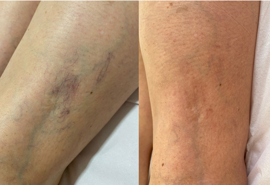 Antes e Depois do Tratamento PEIM