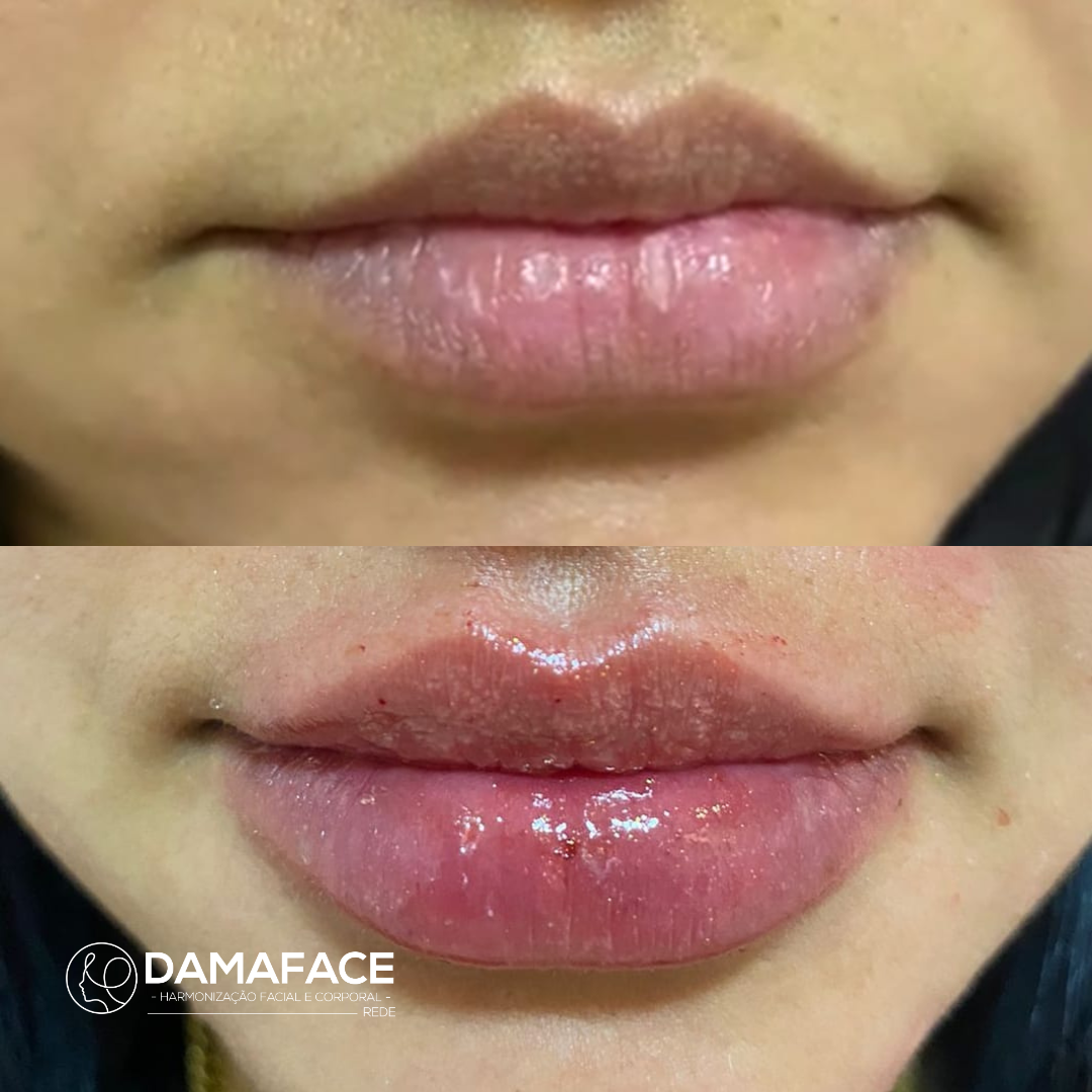 Antes e Depois Lábios