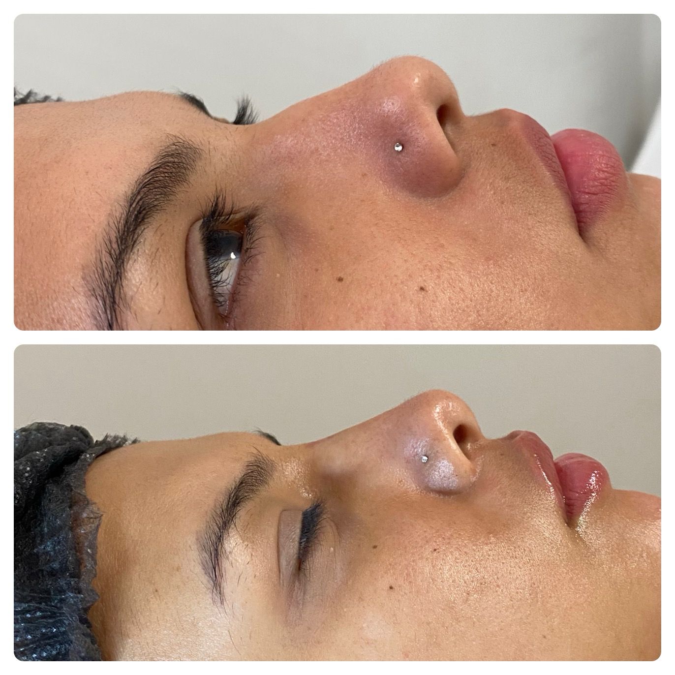 Antes e Depois Rinomodelação