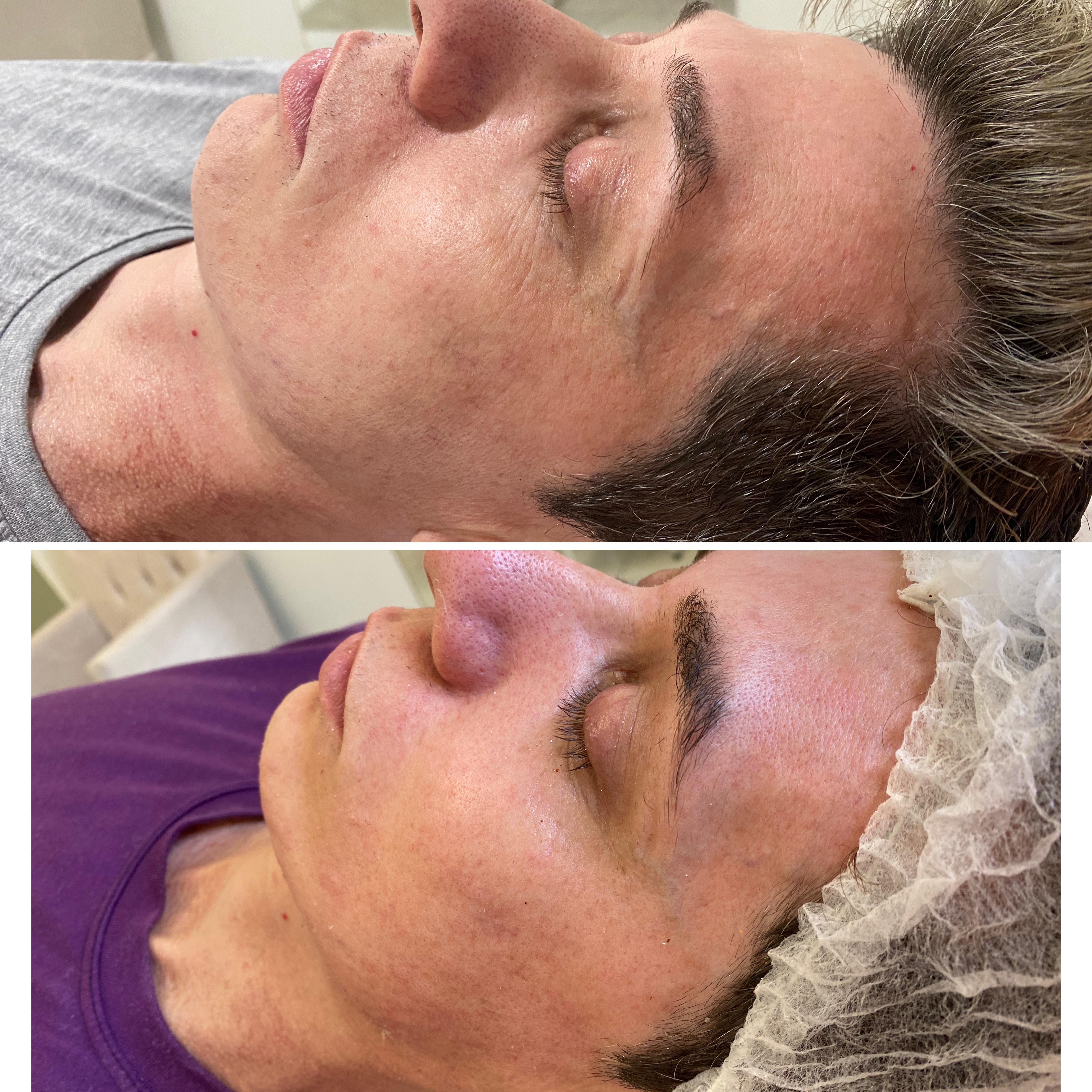 Skinbooster Antes e Depois